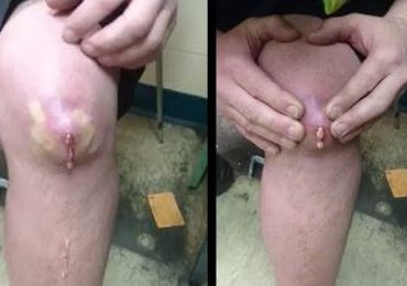 Huge Cyst On Leg Removal Exploding knee cyst