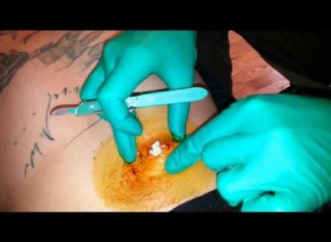 Huge cyst Popped