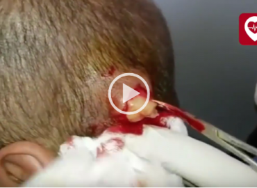 Huge Head Cyst Removal and Extraction