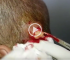 Huge Head Cyst Removal and Extraction