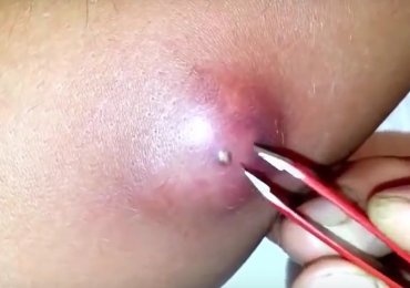 Huge pimple on his arm, pimple explodes like a volcano