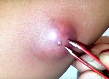 Huge pimple on his arm, pimple explodes like a volcano
