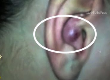 Infected Pimple Extraction On Ear!