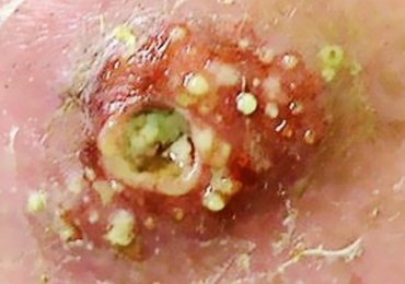 Infections, Cellulitis, Blackheads & Pimple Popping