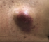 Inflamed Back Cyst POP