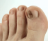 Ingrown Hair in Toe Infected… Pus Drainage