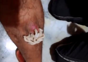Knee Cyst Popped – Never Ending Pus 
