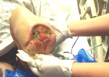 Maggots in wounds coming out of leg Maggots removed and treatment
