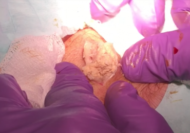 Man Has Giant Cyst Removed