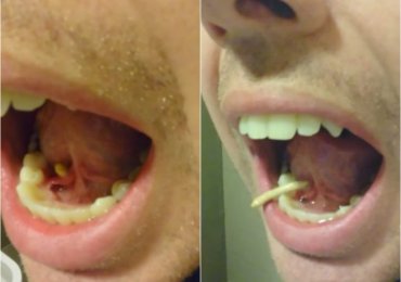Man squeezes salivary stone out from tongue