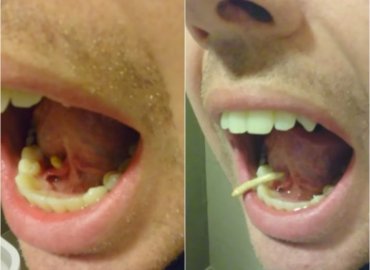 Man squeezes salivary stone out from tongue