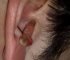 Manifesting Ear Problems Massive Ear Cyst 