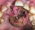 Man’s teeth removed to reveal gums infested with maggots