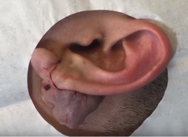 Mass Removed on Ear