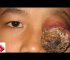 Massive Cyst? Let’s See Removal & Blackhead Mask!