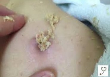 Mega pimples cyst explosion zit on the back removal