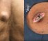 Over 3.9 Million People Have Viewed This ‘Cheesy’ Cyst Removal