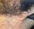 Pimple popping on beard and ingrown hair removed