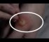 Popping a Giant Blister/Abscess