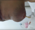 Popping an Infected Cyst Caused by an Ingrown Hair