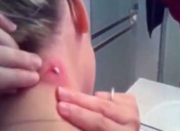 Popping Cyst on Neck and Armpit Cyst Treatment
