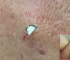 Popping Daily: Big Sebaceous Cyst