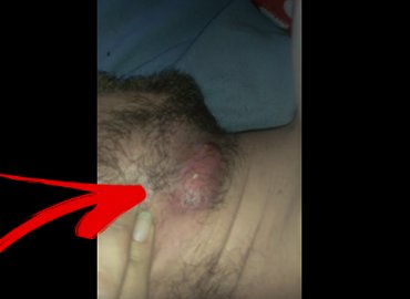 Popping Giant Cyst