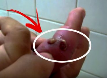 Popping Pus-Filled Infected Finger