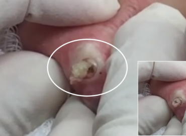 Recurrent Cyst Removed via Punch Biopsy Tool