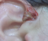 Removal big cyst from the women ear 