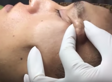 Removal Cysts on The Face