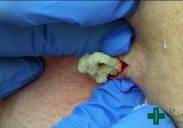 Removal of an Epidermal Cyst on the Lower Back