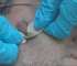 Removal of cyst on right cheek without scars using laser technology