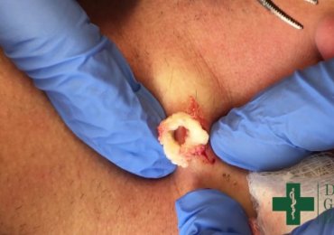 Removal of Epidermal Cyst on the Neck 