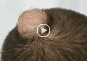 Removing Cyst From The Scalp