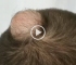 Removing Cyst From The Scalp