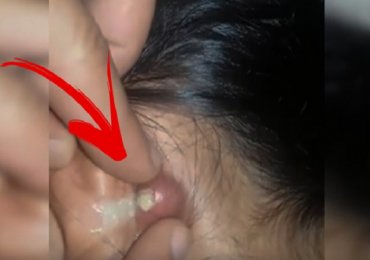 Removing Giant Pimple