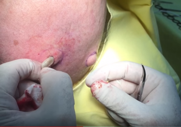 Removing Sebaceous Cysts From The Scalp 