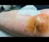 Sebaceous Cyst/Huge popping infected pimples removal