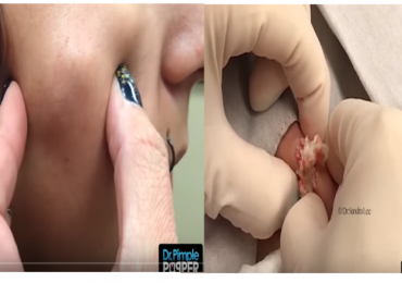 Super Pimple Extraction