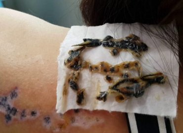 Tattoo Infections Removal