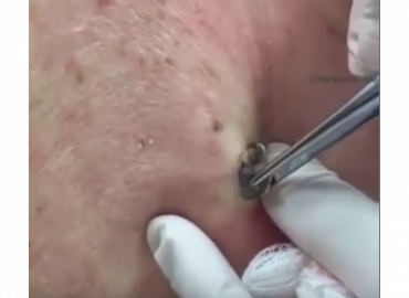The Biggest Dilated Pore of Winer