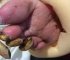 Watch: The World’s Worst Toenails Removals