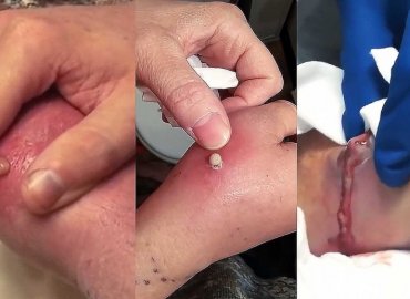 Three large Abscess one the hand