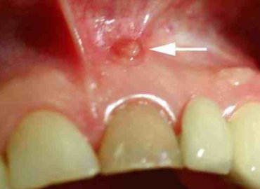 Tooth Cyst Removal