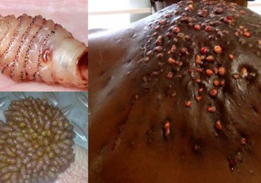 Top 5 Botfly Removal Larva Extraction From Human