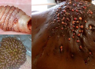 Top 5 Botfly Removal Larva Extraction From Human