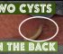 Two Back Cysts Removed with One Punch!