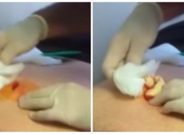 Ultimate Cyst makes a cupful