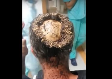 Unbelievable Head Infection Revealing The Skull